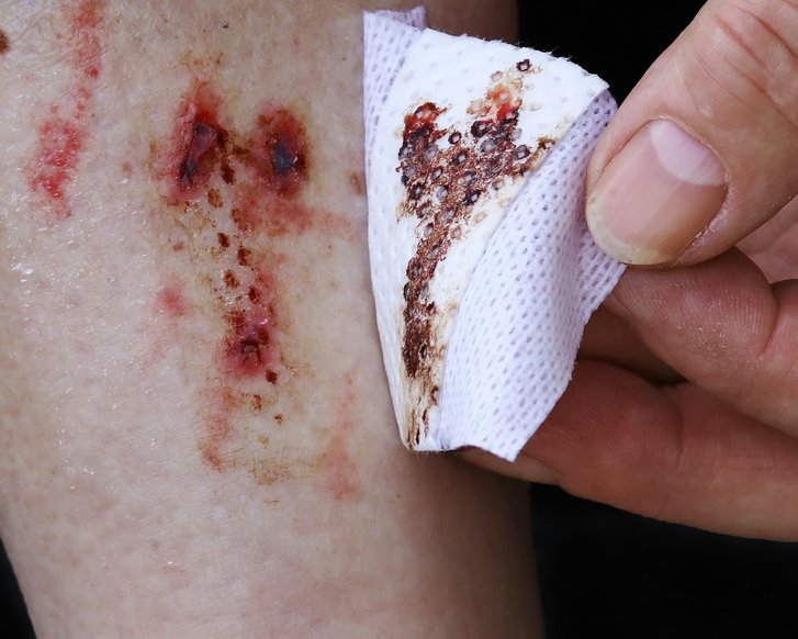Ablösen eines mit der Wunde verklebten Pflasters