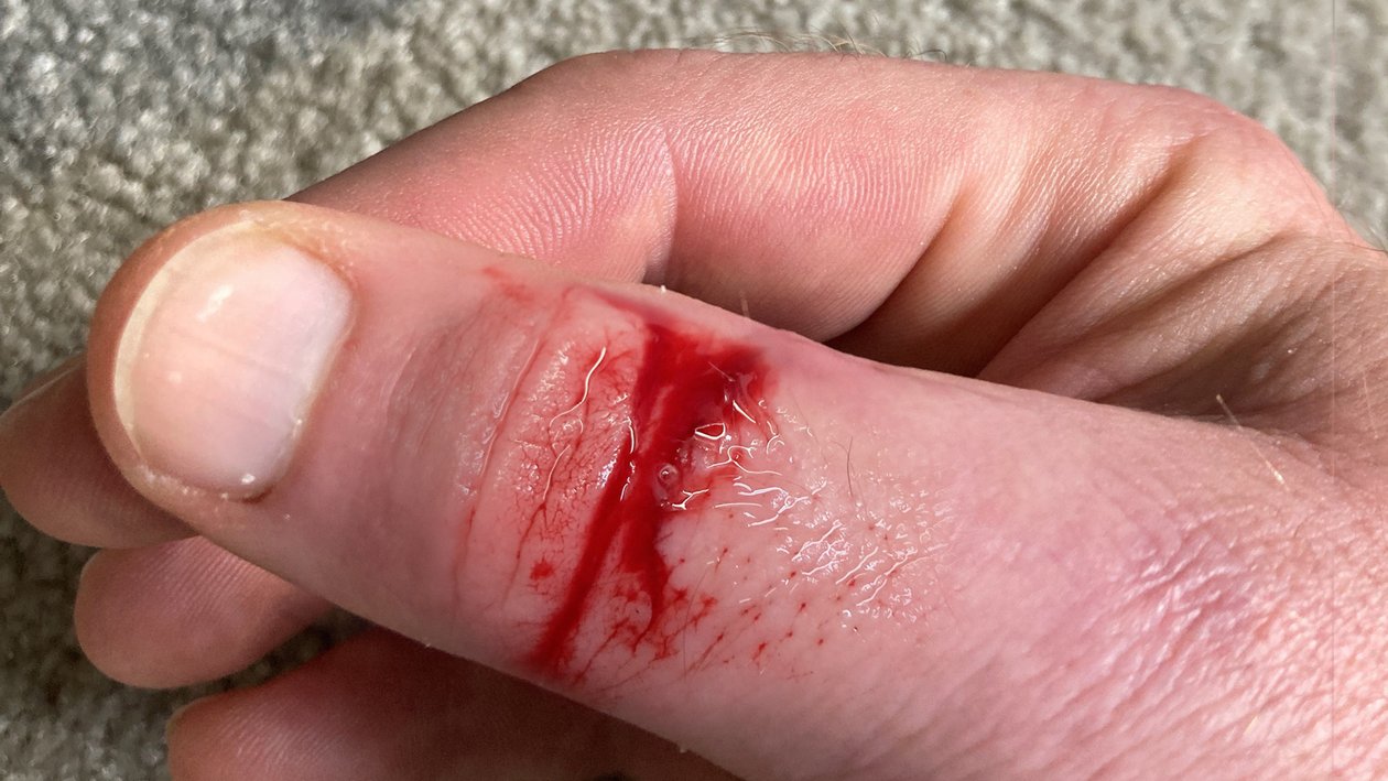 Schnittwunde am Daumen, Vorher-Bild
