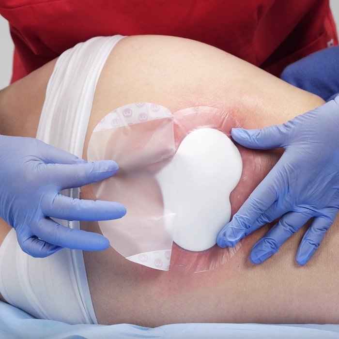 DracoFoam Sakral Versorgung eines Sakraldekubitus