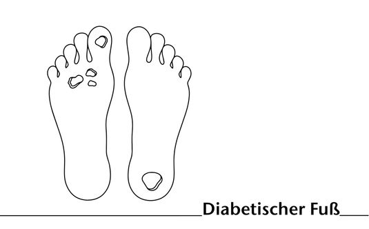 Behandlung des diabetischen Fußsyndroms (DFS): Fokus diabetisches Fußulkus (DFU)