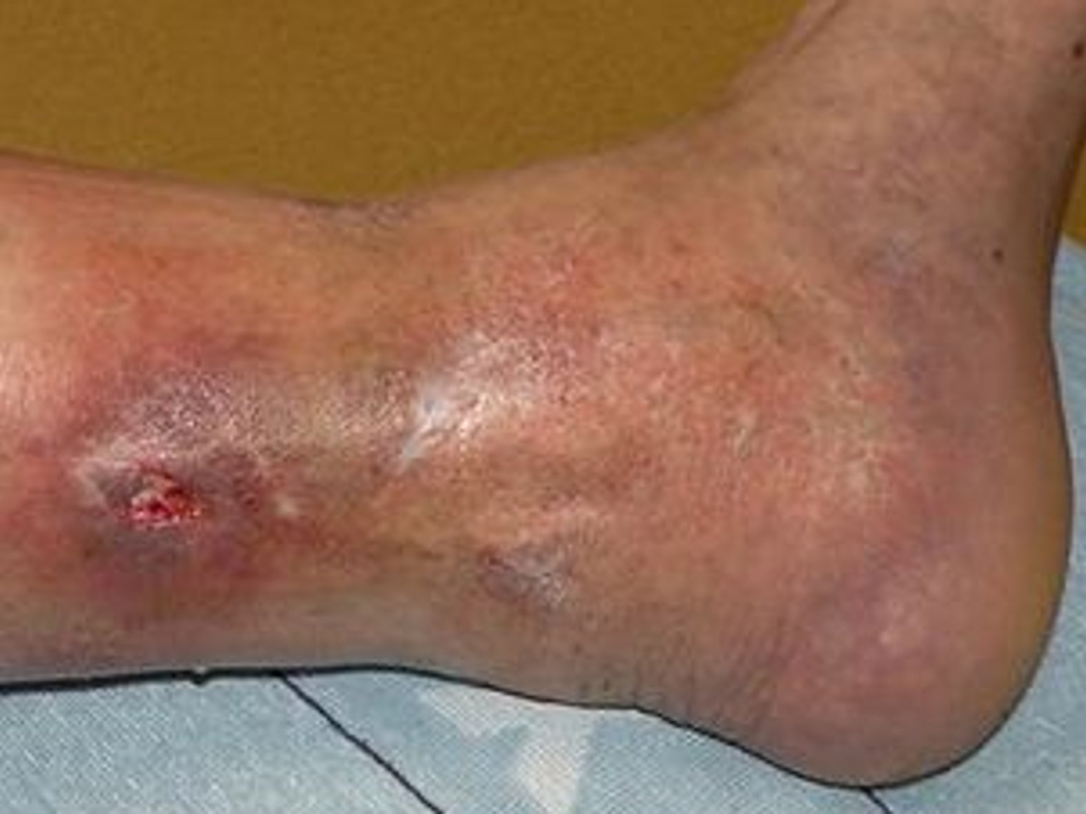 Ulcus cruris mixtum haarlos Sklerose