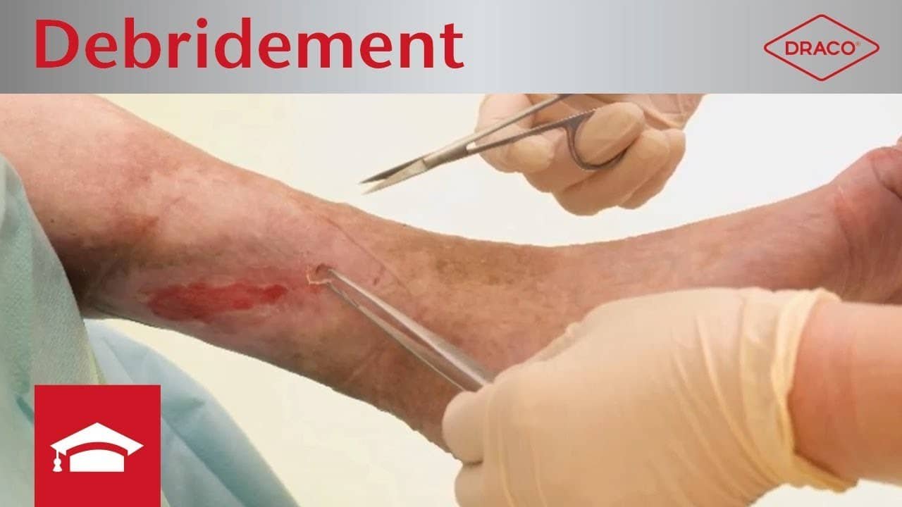 Video: Debridement, Durchführung, Techniken und Methoden