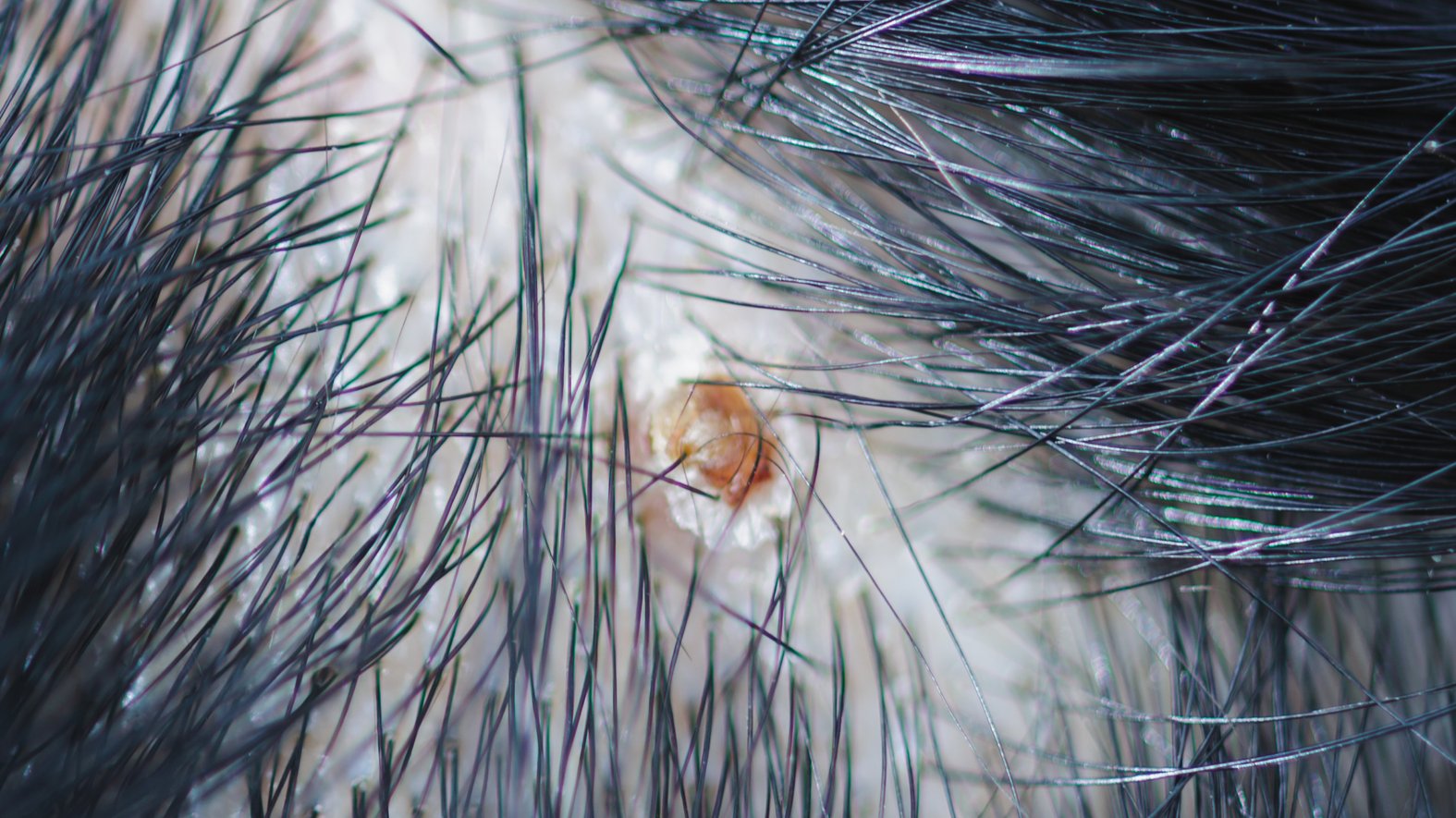 Atherom auf der Kopfhaut