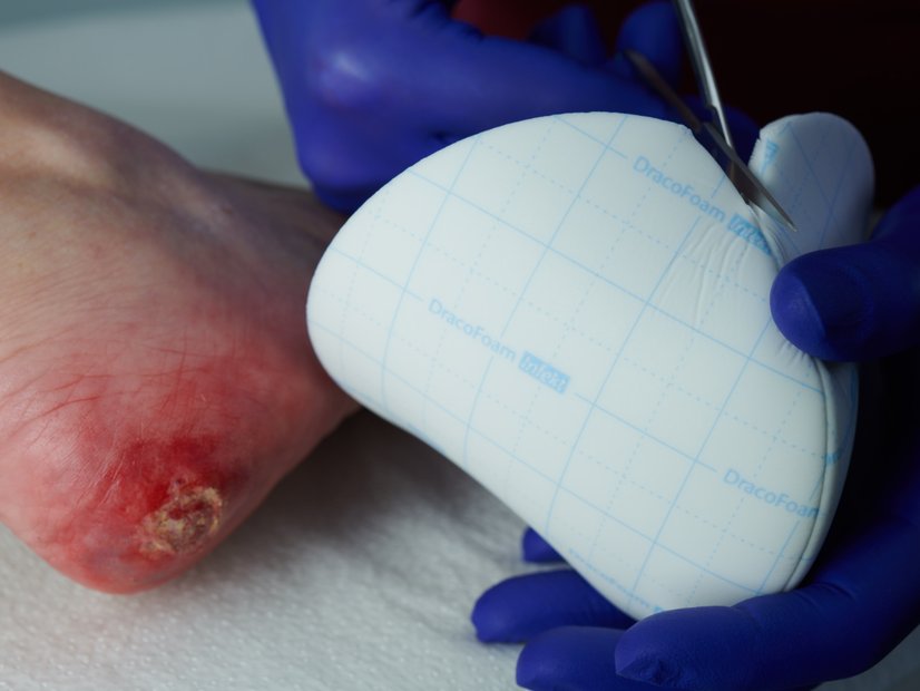 Antimikrobielle Schaumstoff-Wundauflage Dracofoam infekt Ferse, Anwendung