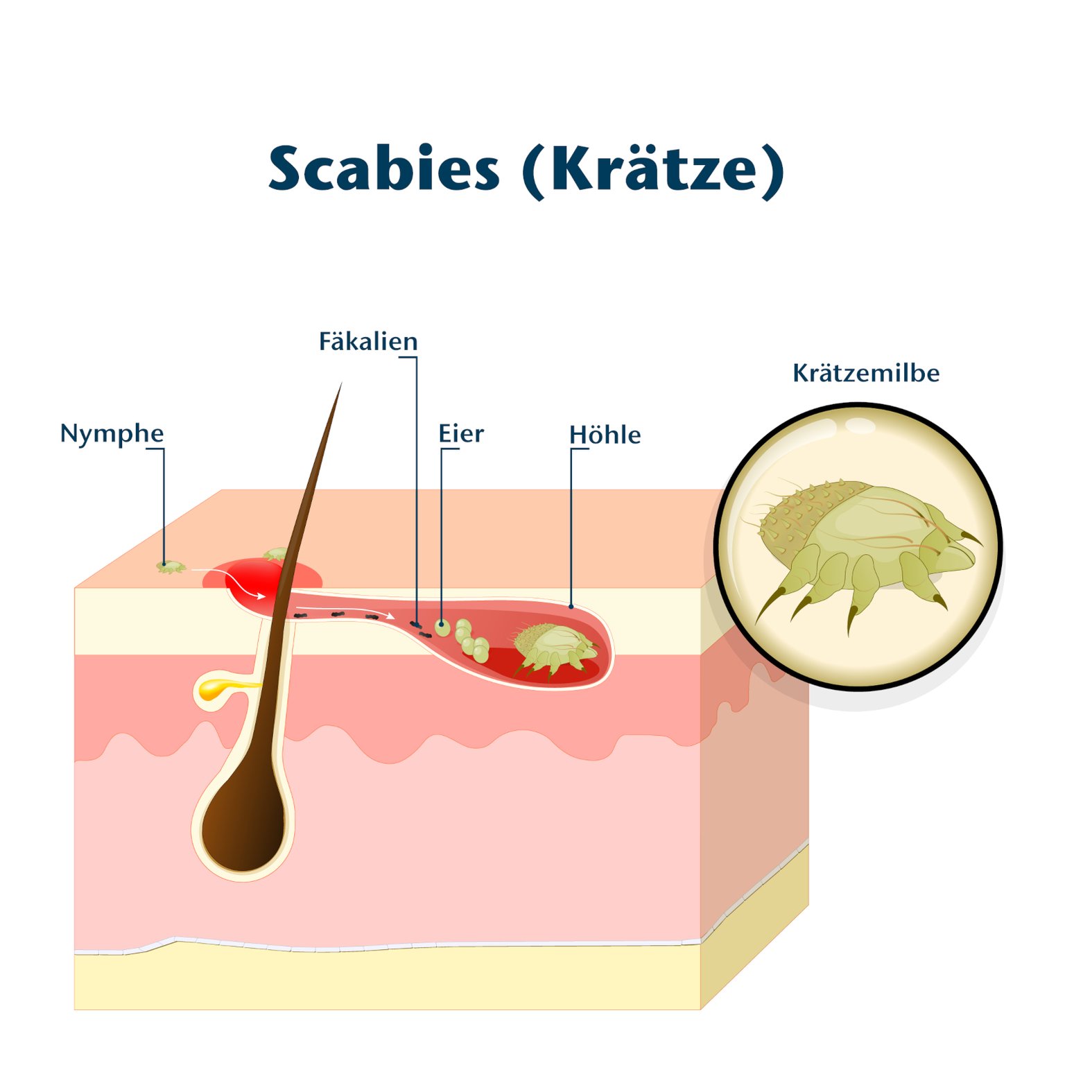 Schema: Scabies, Krätze, Krätzemilbe in der Haut