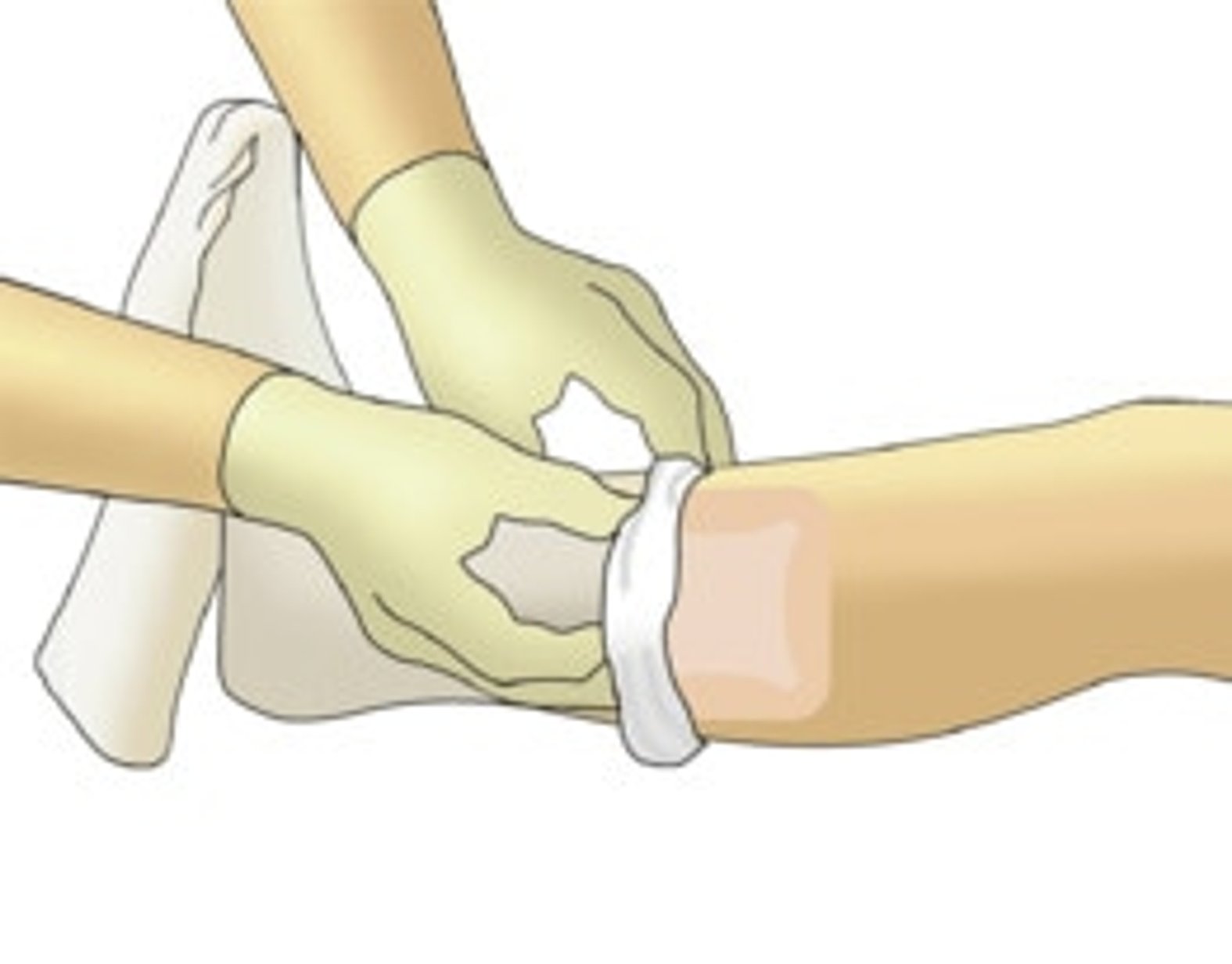 Kompressionverband Ulcus Cruris Venosum Schritt 2