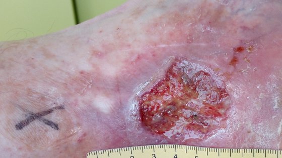 Fallbeispiel: Ulcus cruris venosum bei Perforansinsuffizienz