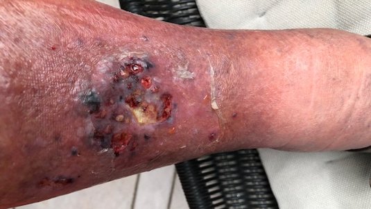Pyoderma gangraenosum