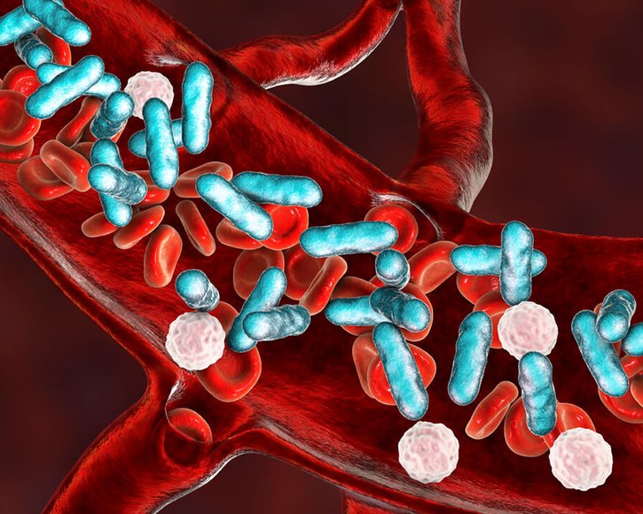 Sepsis früh erkennen und schnell handeln: Was Sie wissen sollten