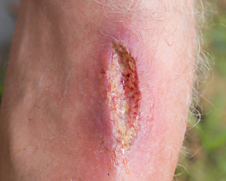 Fleischwunden: Umgang mit einem ungenauen Begriff