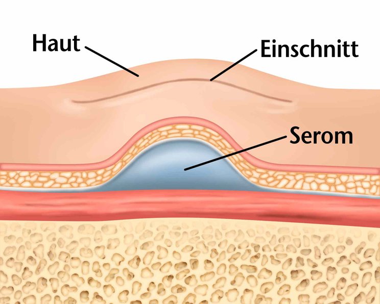 Serom: Serome und Pseudozysten