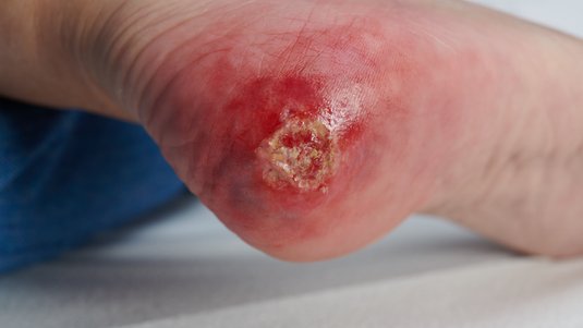 Mit dem „TILI-Score“ lokale Wundinfektionen frühzeitig erkennen