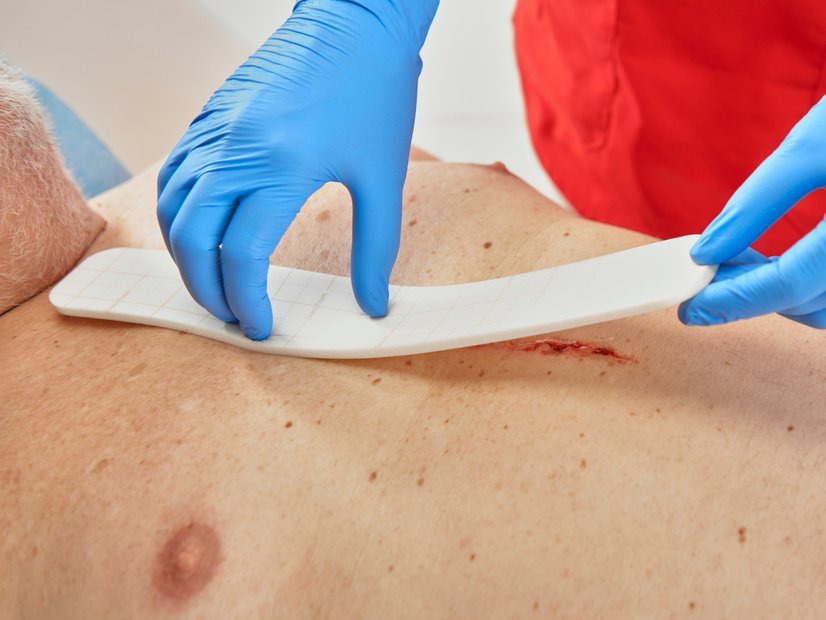 DracoFoam Sondergröße 5x30cm, Versortung einer Wunde auf der Brust