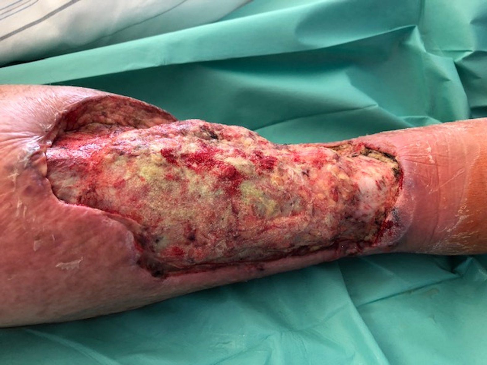 Ulcus am rechten Unterschenkel 2