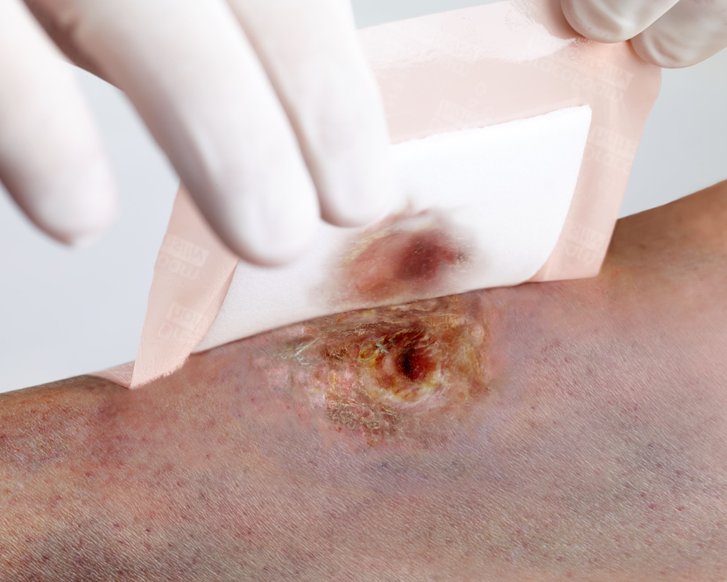 DracoFoam sensitiv wird von empfindlicher Wundumgebungshaut abgezogen