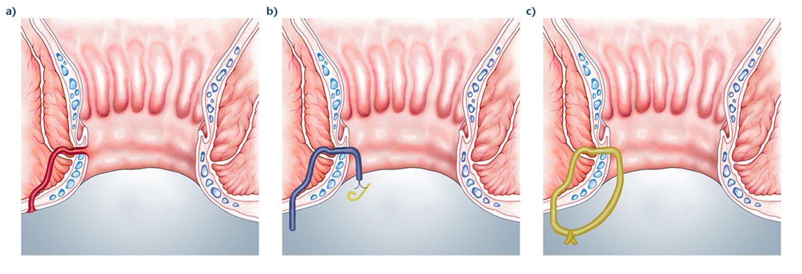 Fadendrainage einer Analfistel, Illustration