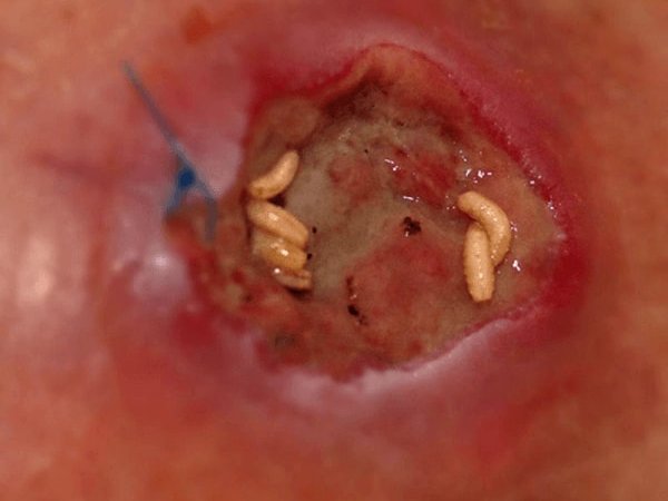 Biochirurgisches Débridement: Madentherapie