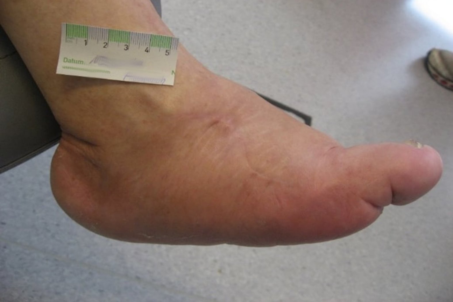 Angeschwollener Fuß mit Charcot-Arthropathie