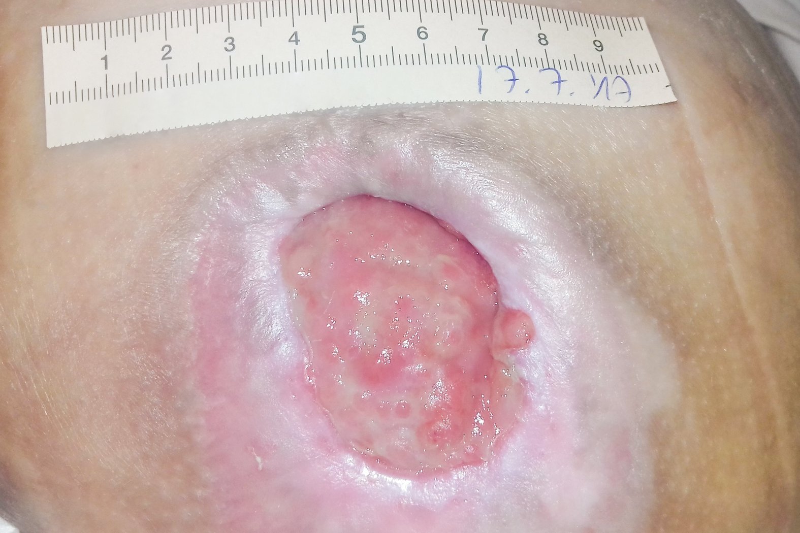 Foto 2: Wunde mit rückgängiger Mazeration und Unterminierung (Tag 46)