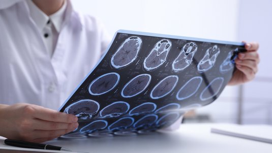 MS – Die vielen Gesichter der Multiplen Sklerose