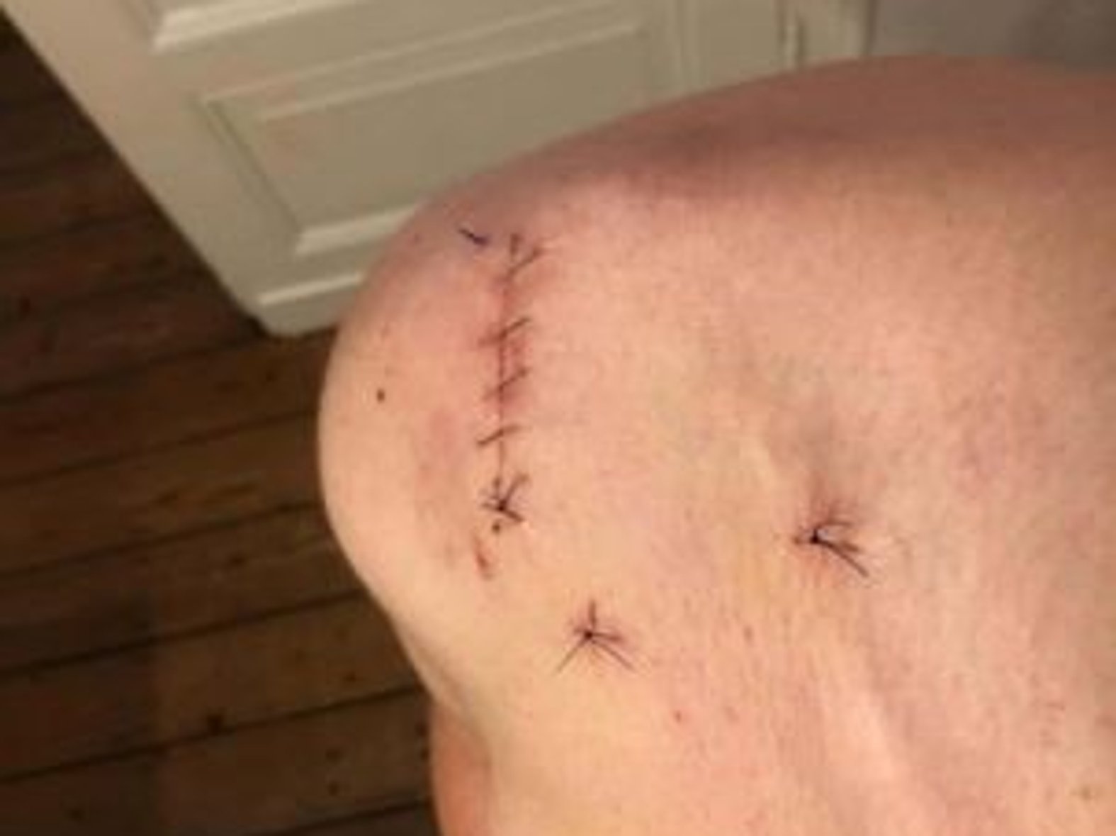 Leicht abgeheilte OP Wunde mit Faeden