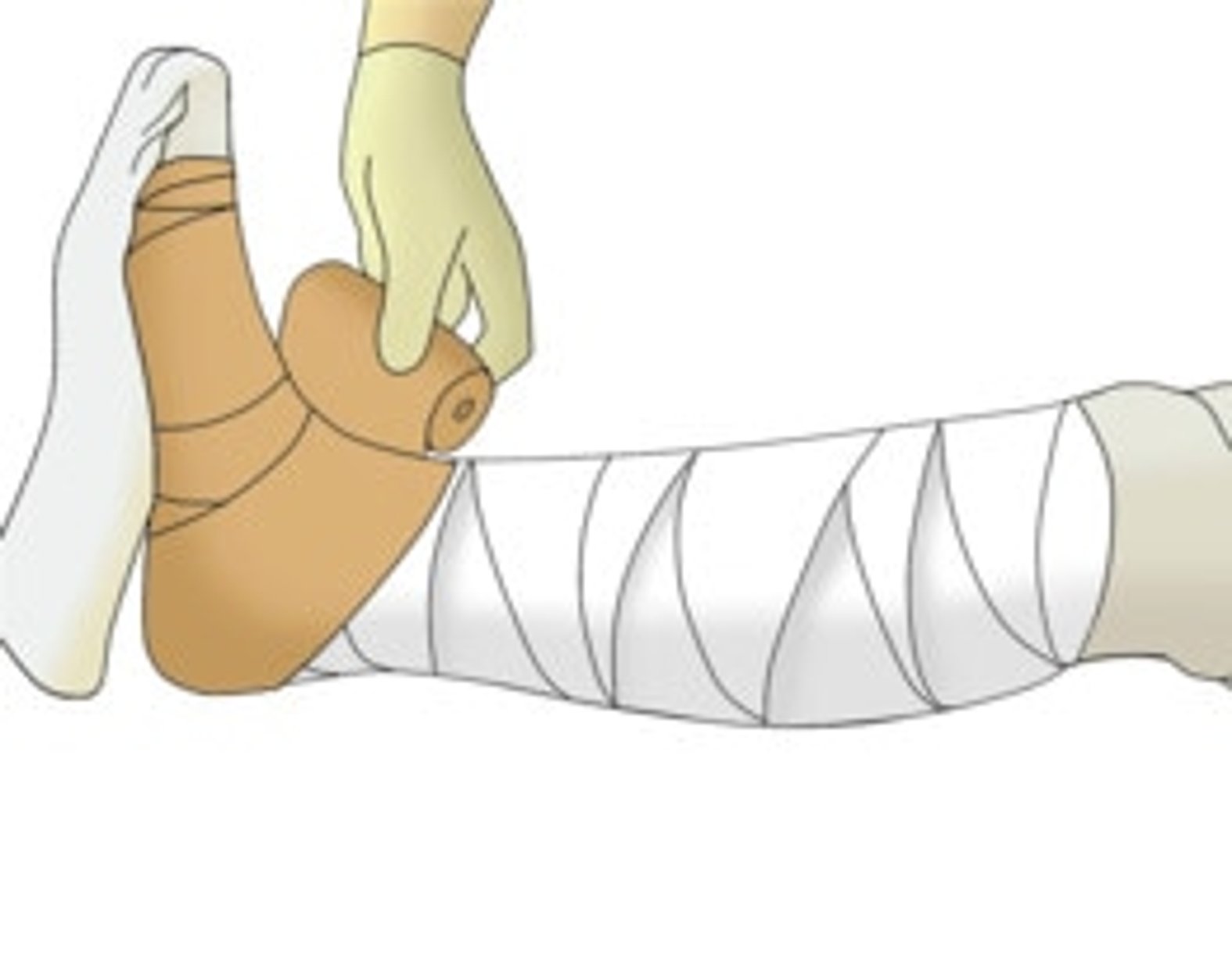 Kompressionverband Ulcus Cruris Venosum Schritt 10