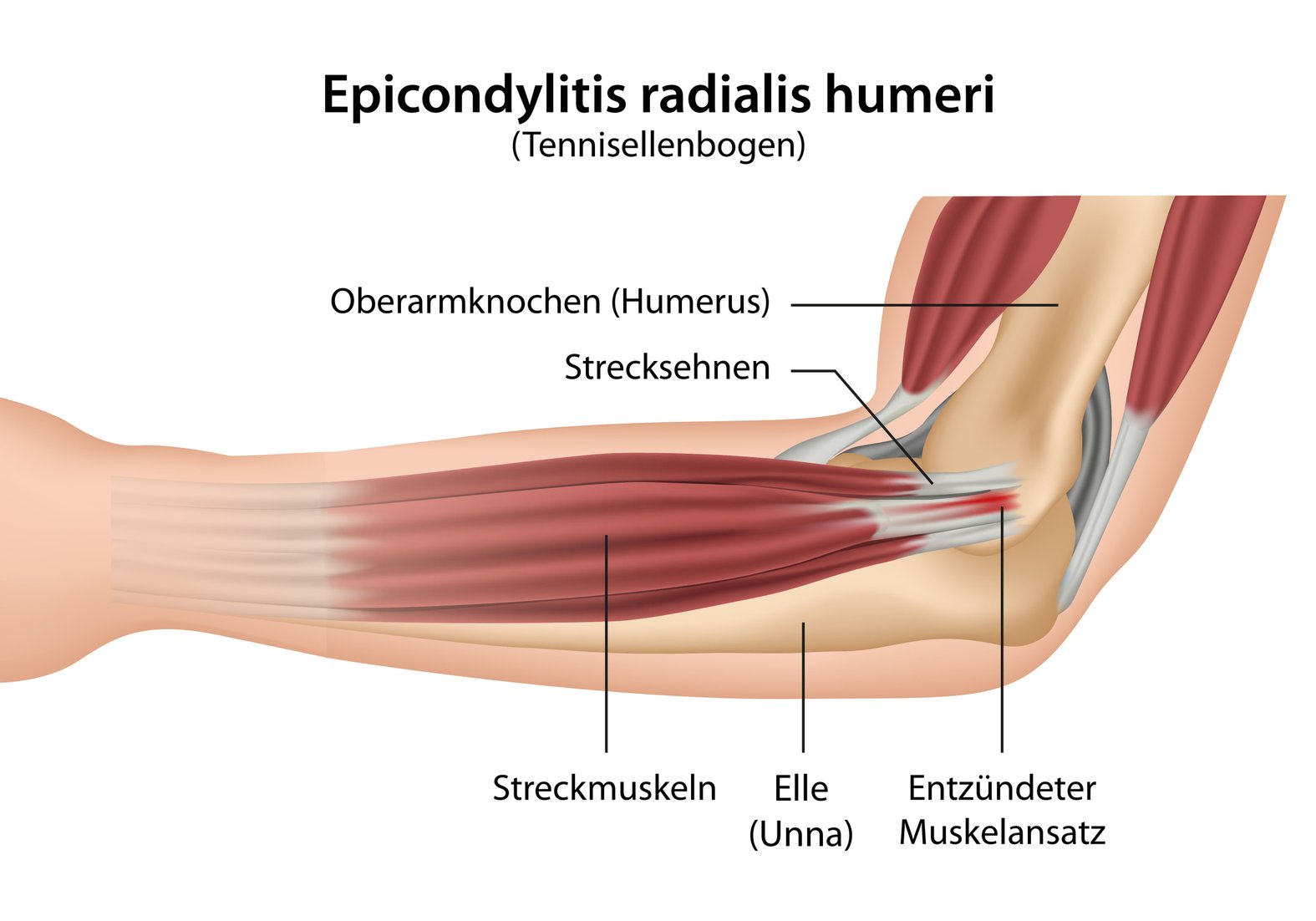 Anatomie Tennisellenbogen