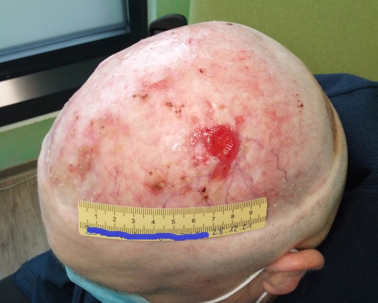 Wundheilungsstörung: Schlecht heilende Wunden