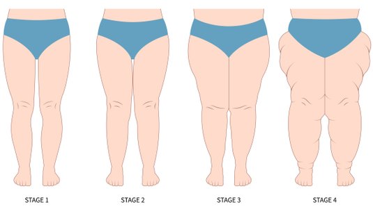 Lipödem – das unbekannte Krankheitsbild