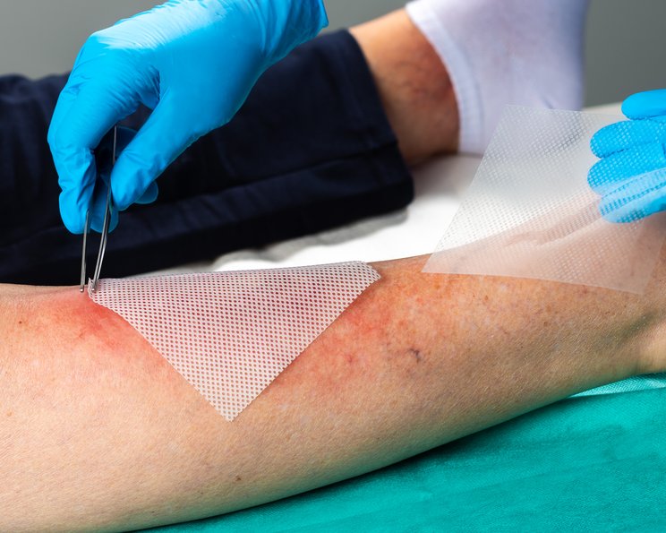 Fettgaze oder Silikon-Distanzgitter