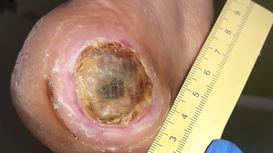 Fallbeispiel: Fersendekubitus mit Nekrose