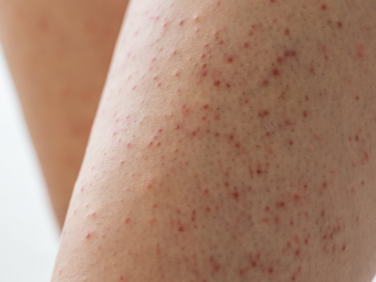 Keratosis pilaris am Arm
