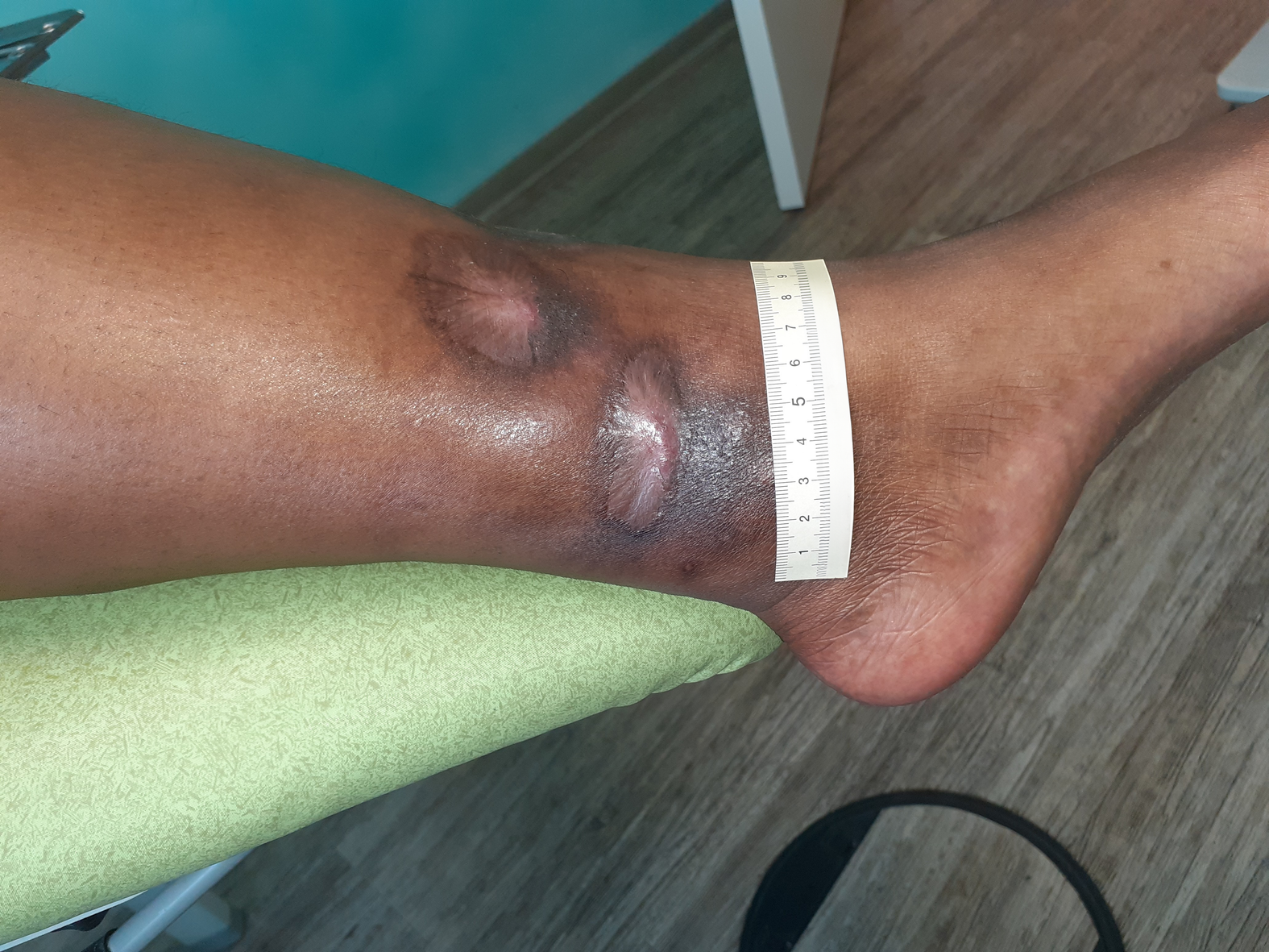 Foto 9: Abgeheilte Wunde am Unterschenkel medial (Tag 201)