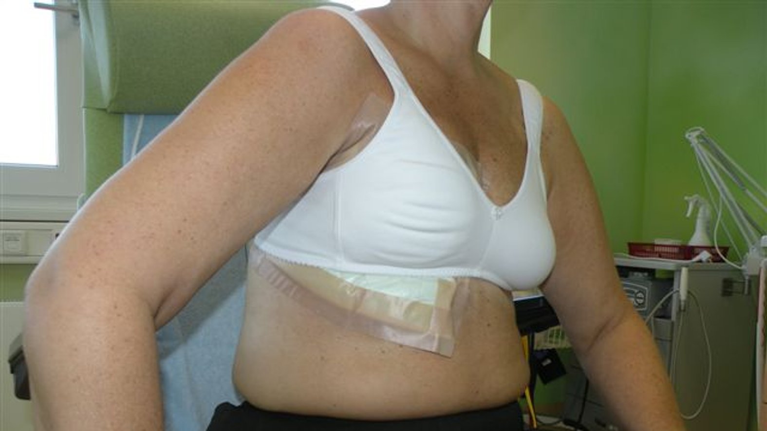 Fallbeispiel: Palliative Versorgung eines Exulzerierenden Tumors – Zusätzliche Fixierung mit weichem BH