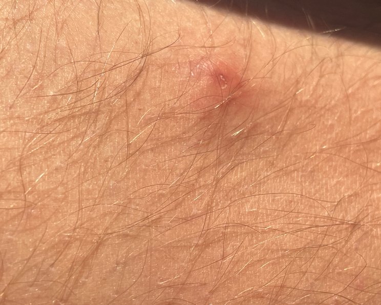 Scabies (Krätze) erkennen und behandeln – so haben die lästigen Milben keine Chance