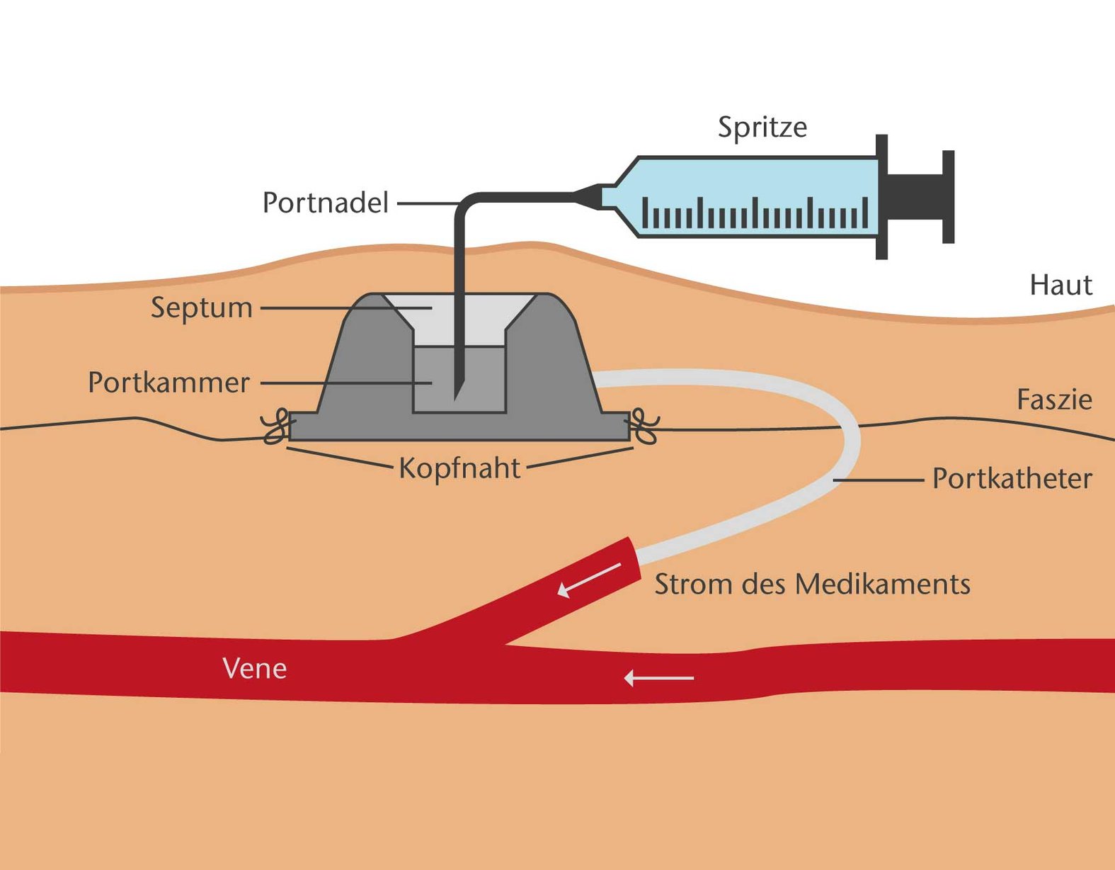 Portpflege: Schematische Darstellung einer Portversorgung