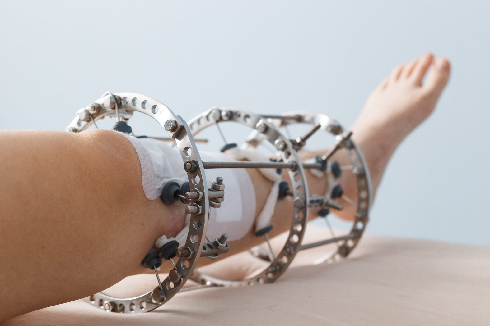 Fixateur externe am Bein, Ringsystem und Pins