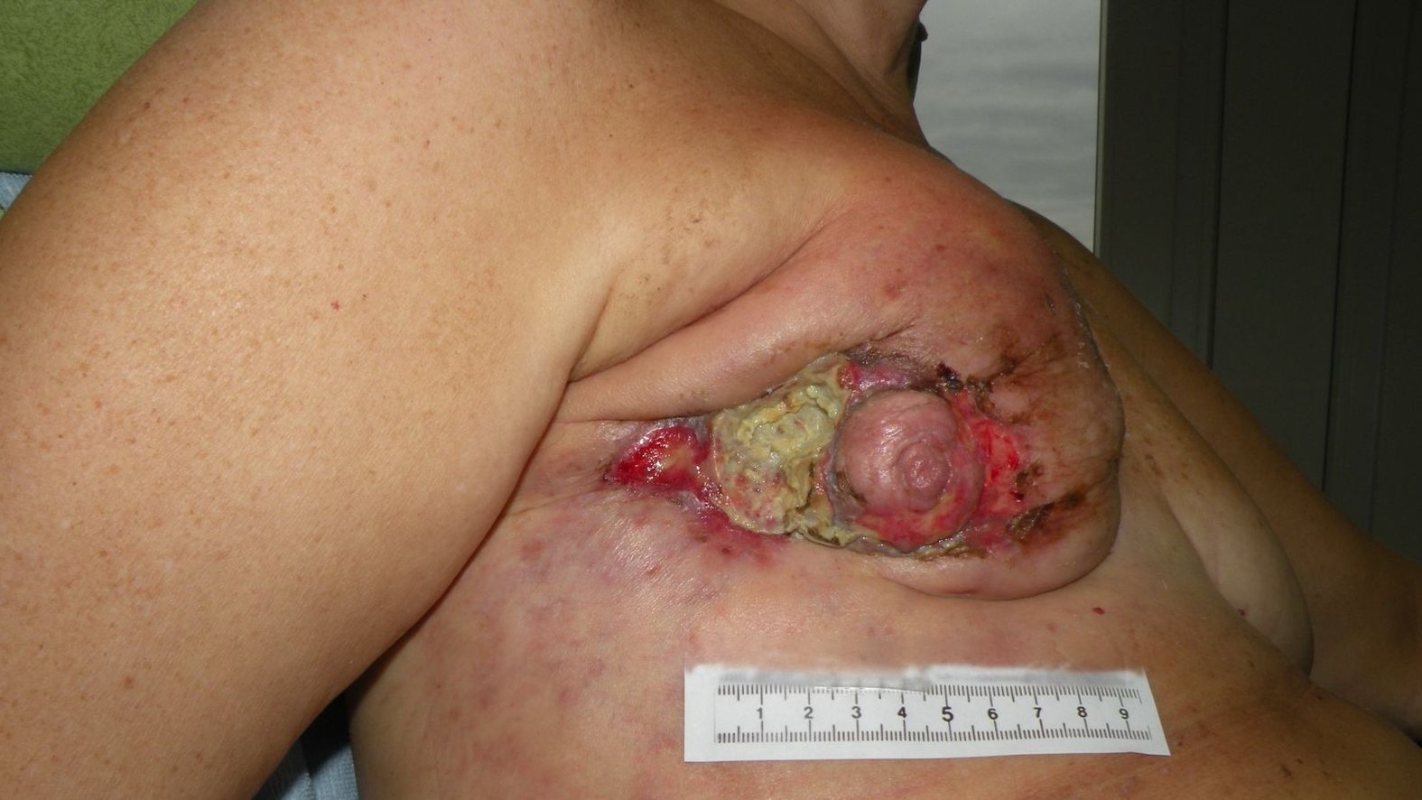 Fallbeispiel: Palliative Versorgung eines Exulzerierenden Tumors – Ausgangssituation