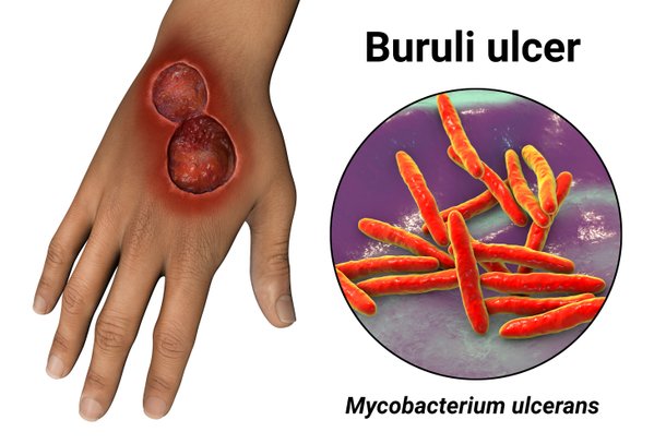 Buruli-Ulkus, schematische Darstellung Geschwür und Erreger