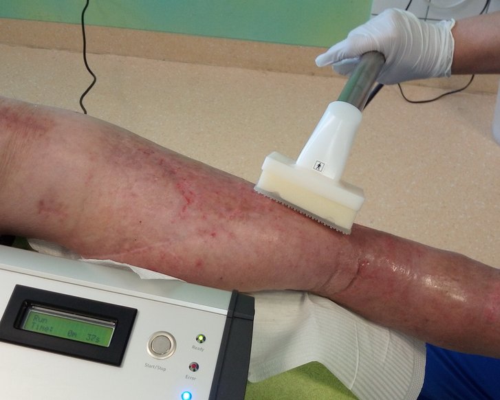 Forschung: Plasmatechnologie für die Wundbehandlung