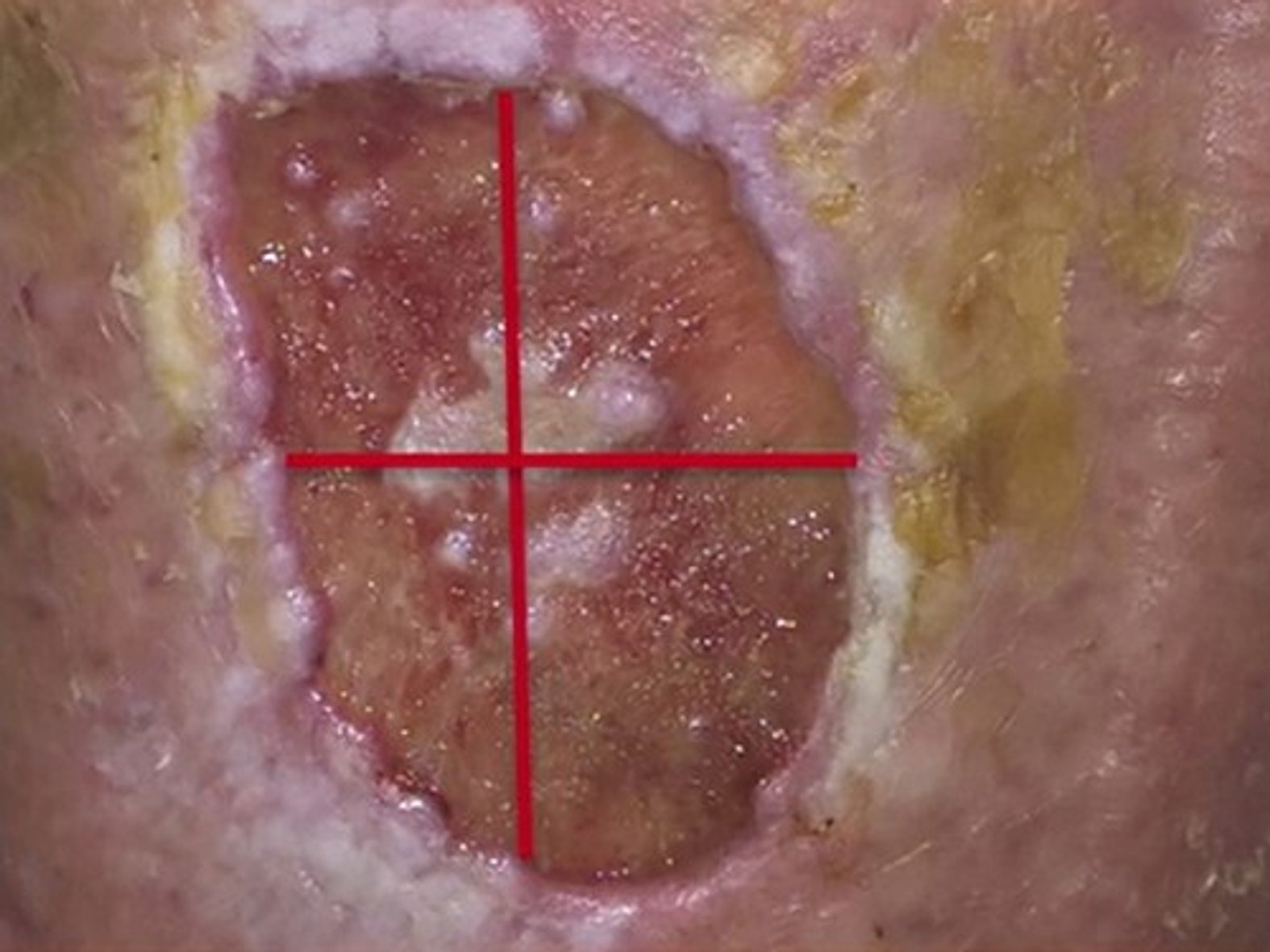 Wundvermessung Länge und Breite nach Körperachse