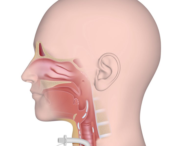 Versorgung eines Tracheostoma: Reinigung und Pflege