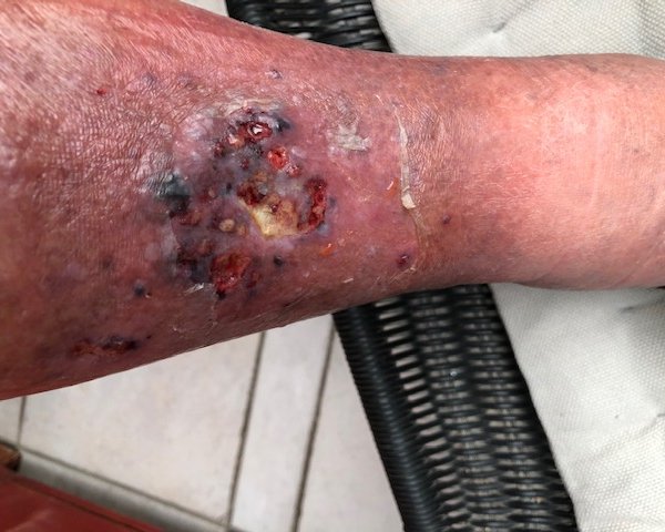 Von der kleinen Verletzung zur chronischen Wunde