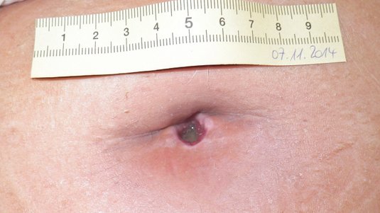 Fallbeispiel: Infizierte OP-Wunde am Bauch