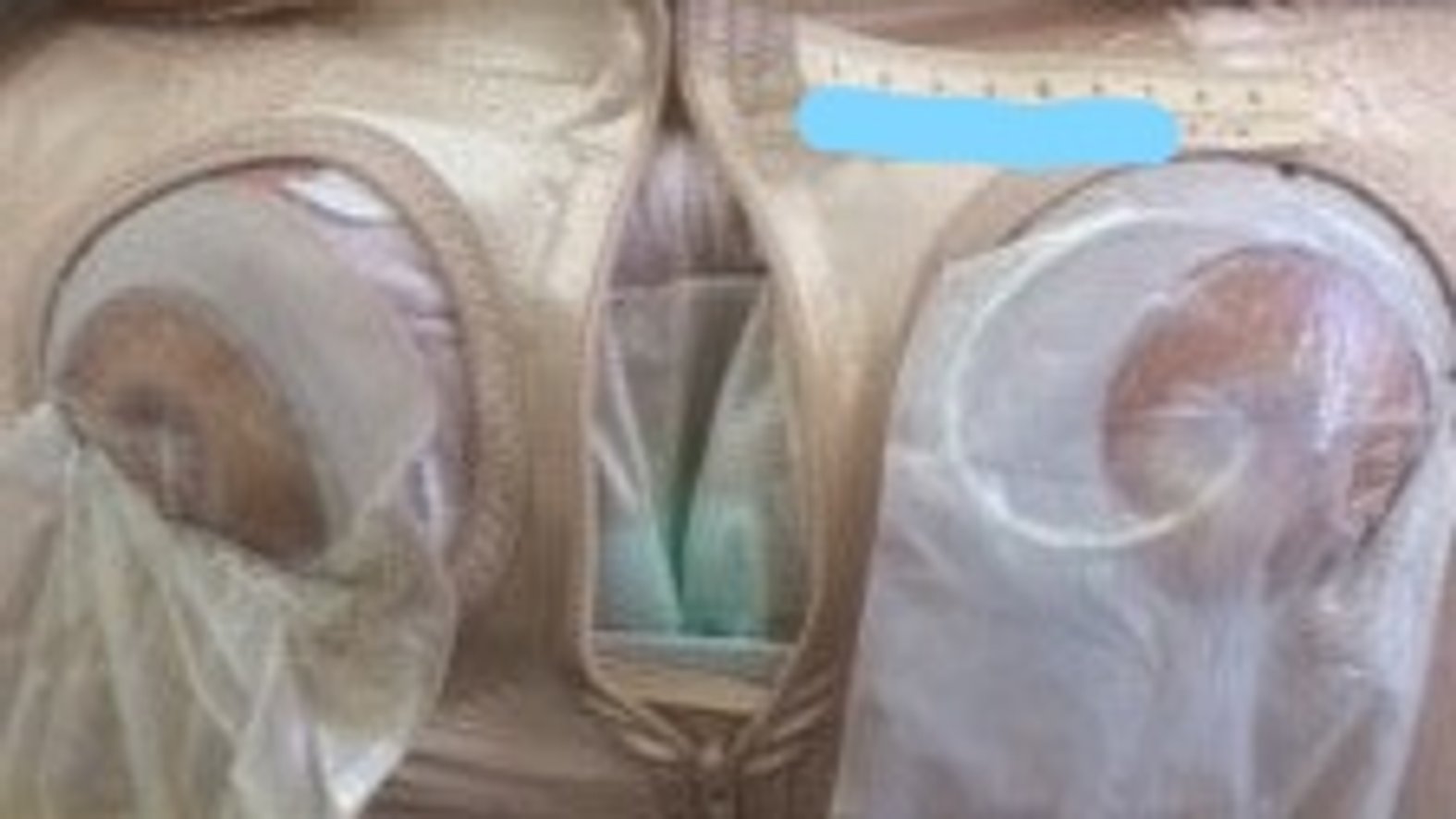 Bauchwunde_mit_Stomaanlagen – Zusätzliche Fixierung mit speziellem Mieder