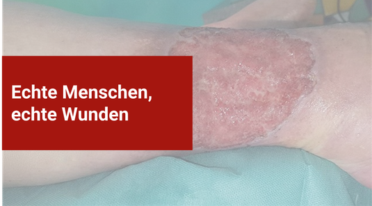 Fallbeispiel: Stark exsudierende Wunde – wie würdest du entscheiden?