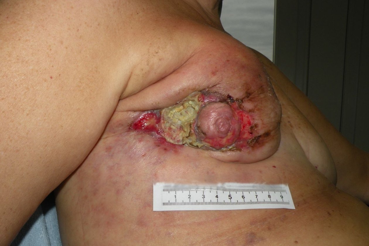 Fallbeispiel: Palliative Versorgung eines Exulzerierenden Tumors – Ausgangssituation