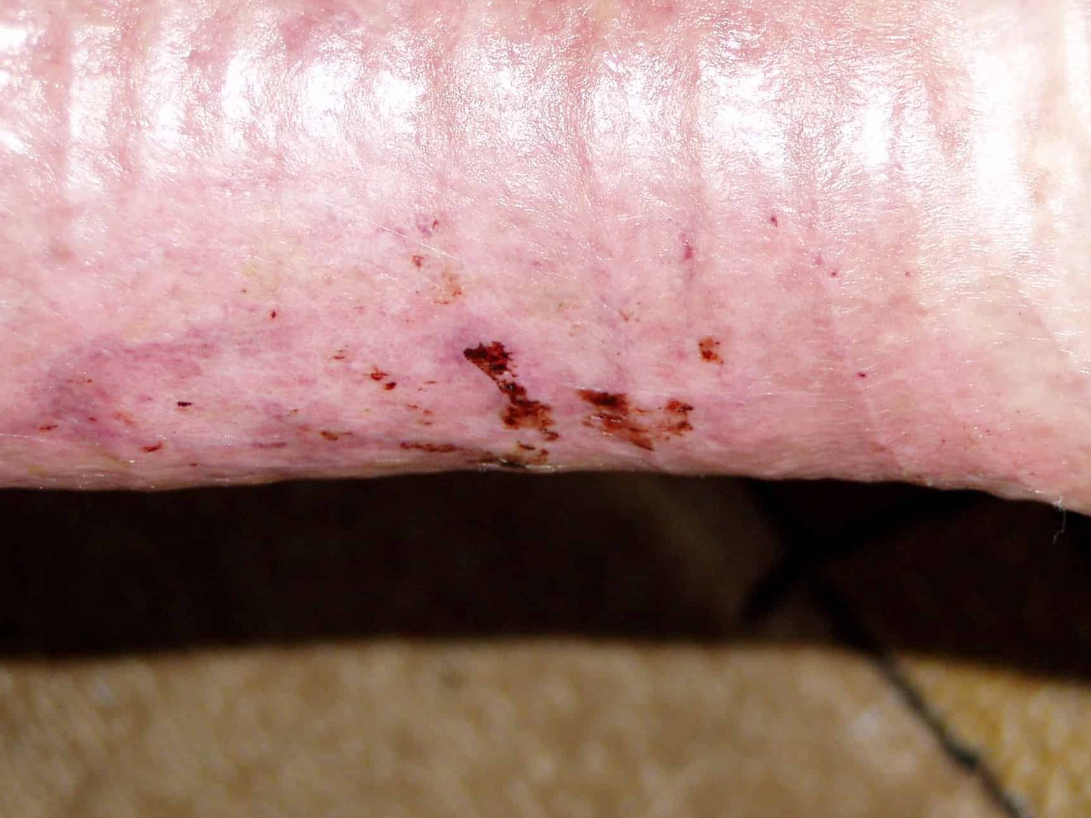 Ulcus cruris venosum Wunde