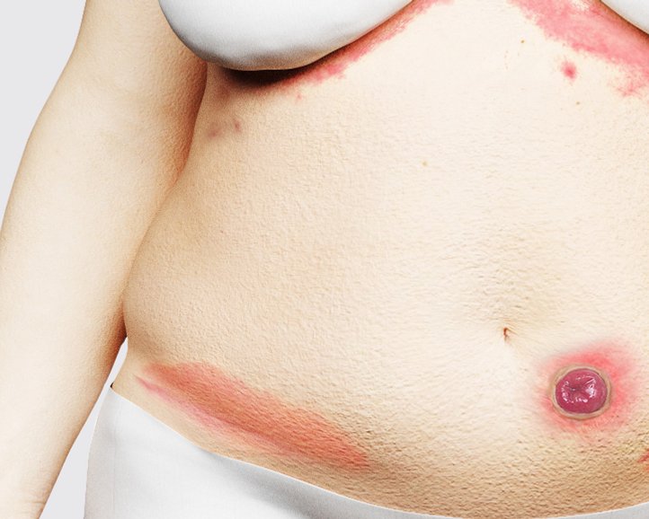 Flüssigkeits-assoziierte Hautschäden (FAH): Ursachen, Klassifikationen, Prävention