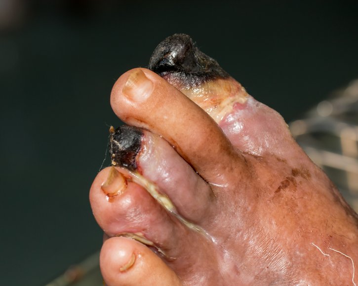 KI soll Wundversorung bei Diabetes verbessern 